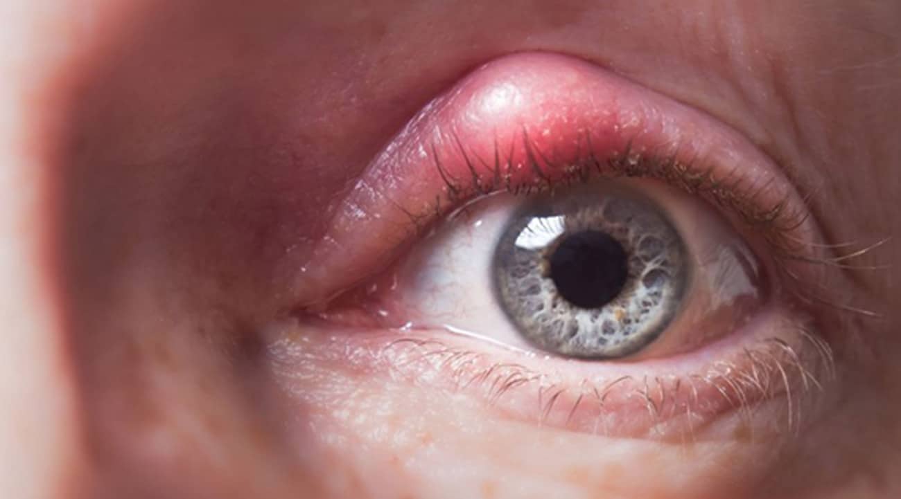 Chalazion